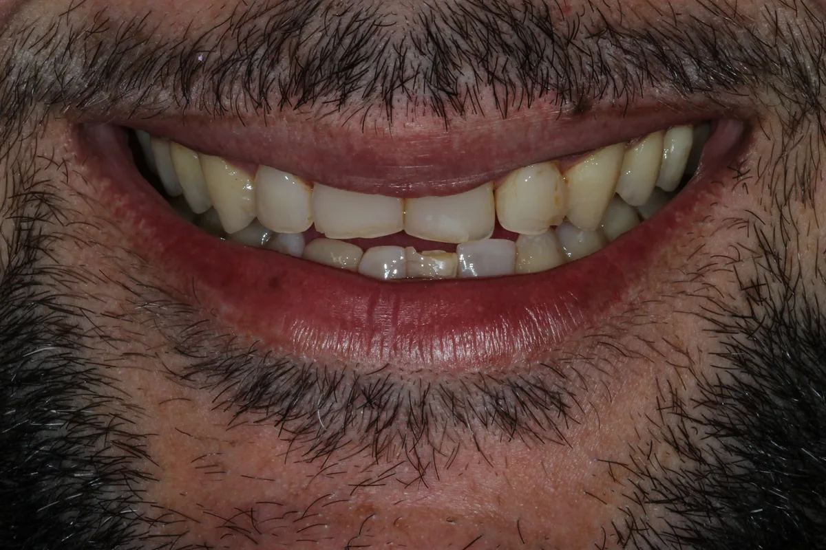 Antes — Reabilitação estética do sorriso, sorriso (caso real, Landgraf Odontologia Premier)