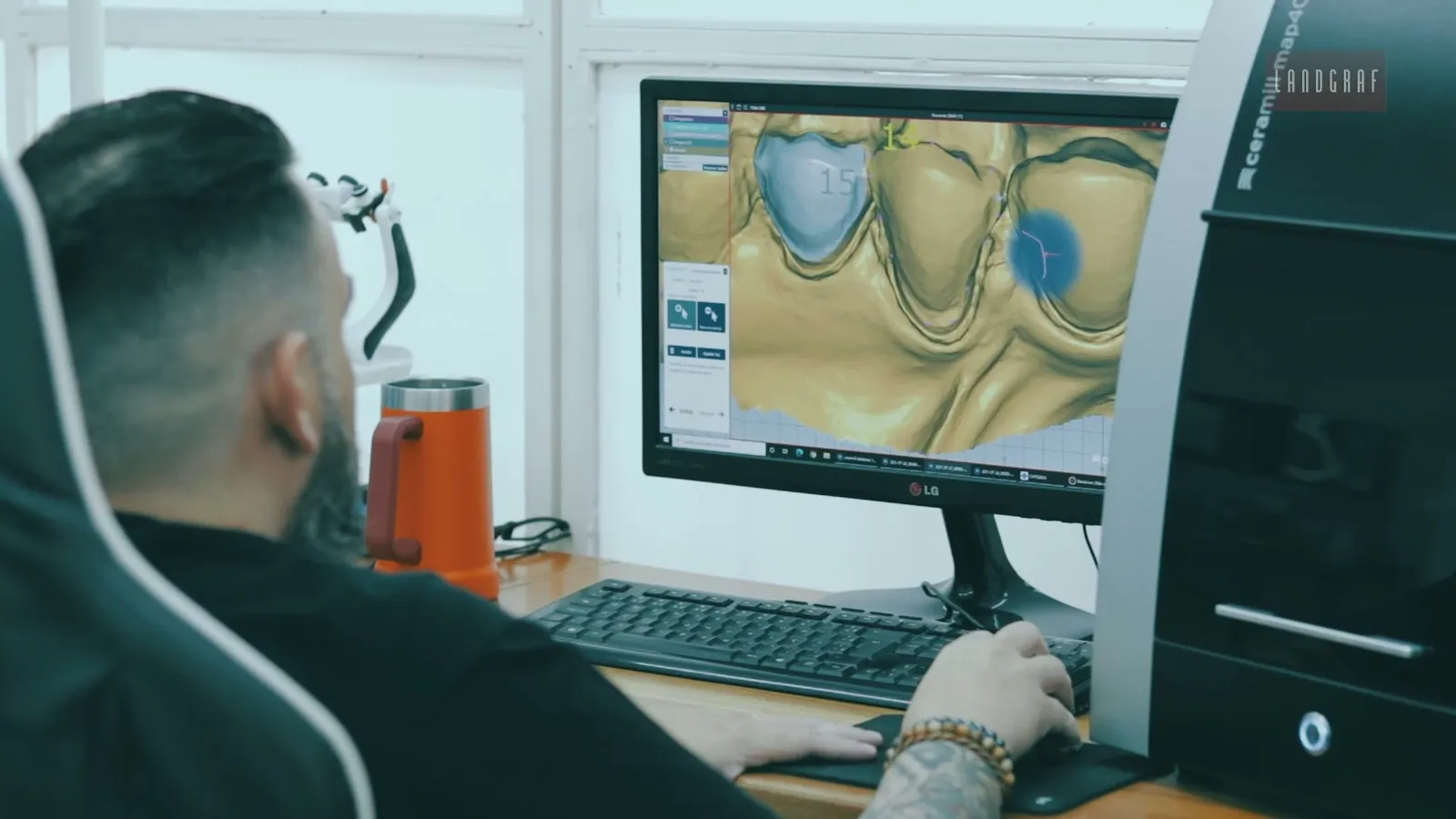 Planejamento digital do tratamento em software 3D, na própria clínica